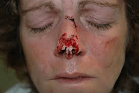 This lady was actually lucky that the dog did not injure her eye. Even so, she had to undergo reconstructive surgery because of the dog bite. - dogbite-injury