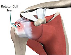 Shoulder Surgery Accident Injury Lawyers MN