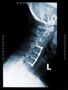 A x-ray of the back of a person 's neck.